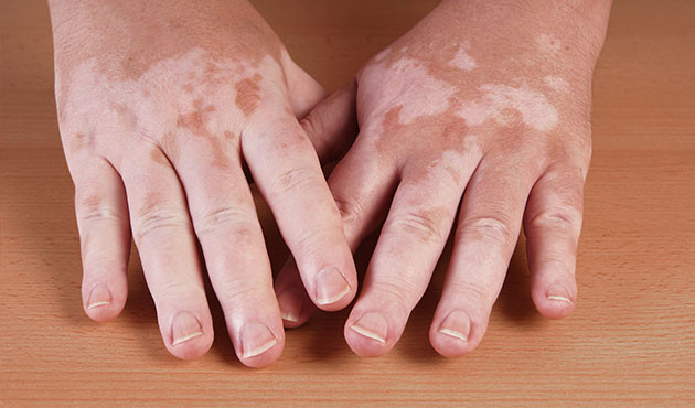 foto_vitiligo1